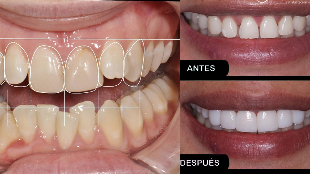 Diseño de sonrisa en Juliaca: Presume una sonrisa ADMIRABLE