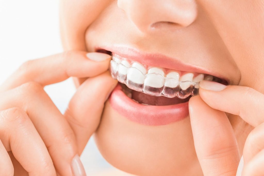 Ortodoncia Invisible en Juliaca: Alinea tu Sonrisa de Forma Discreta