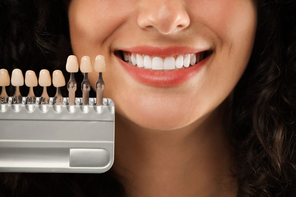 Carillas Dentales en Juliaca: Mejora tu Sonrisa de Forma Natural