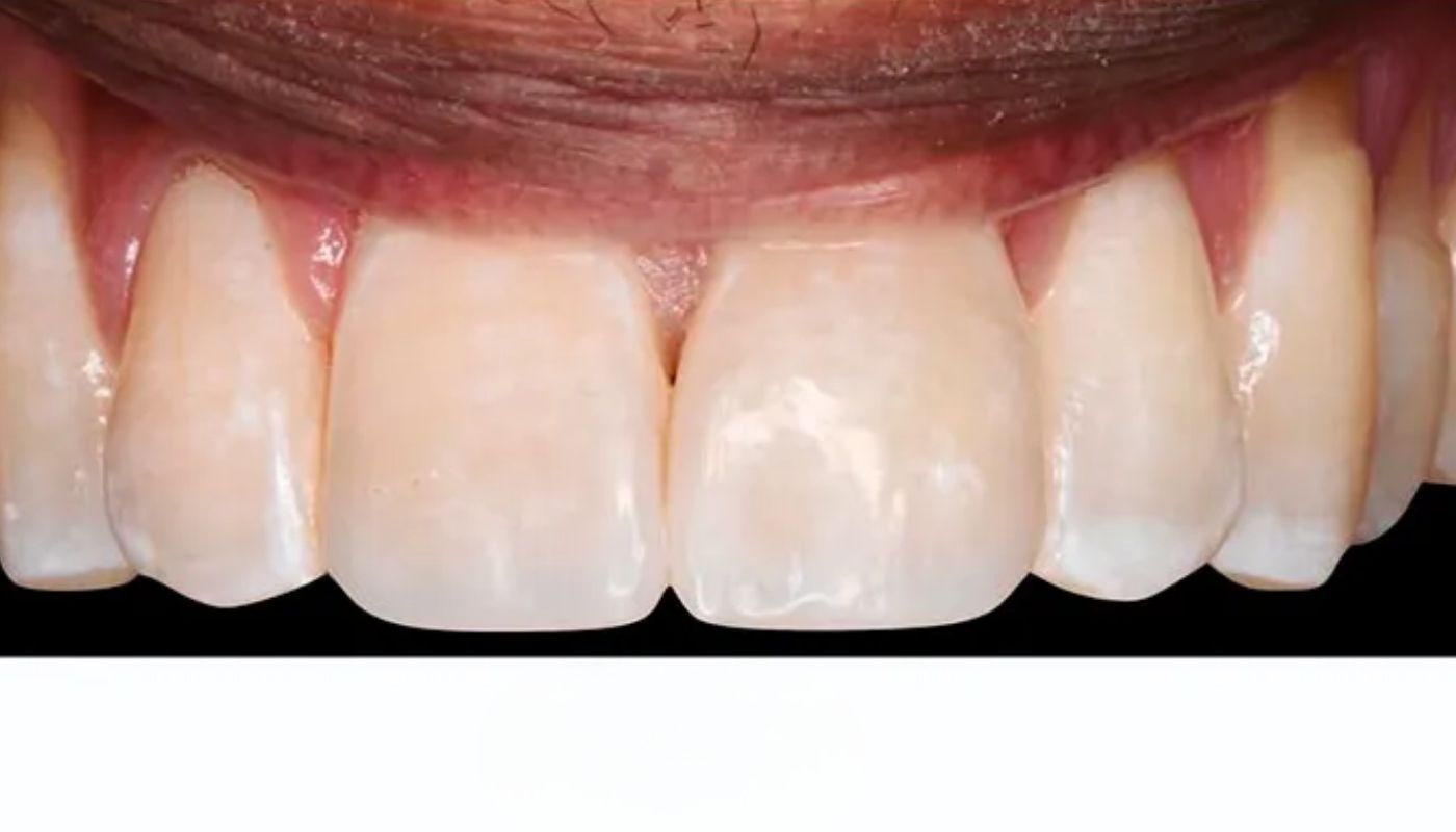 antes y despues (2)