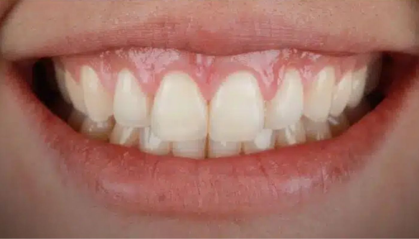 antes y despues (2)