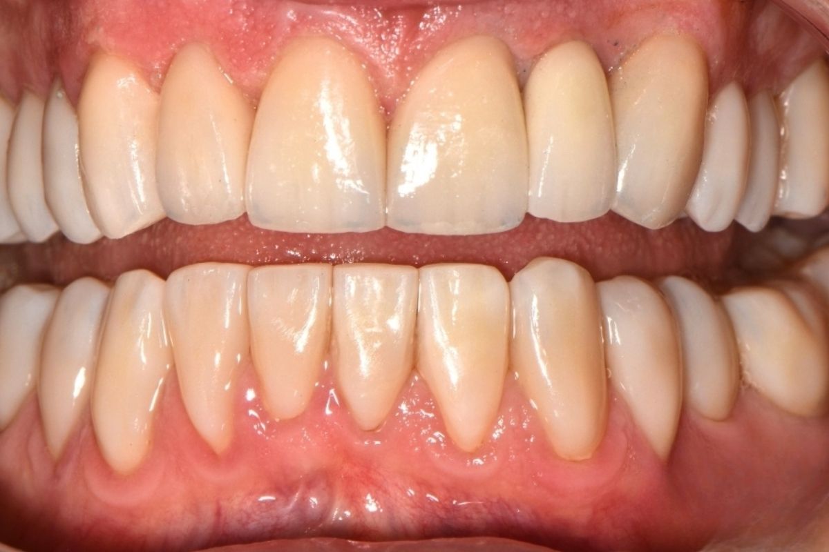antes y despues (2)
