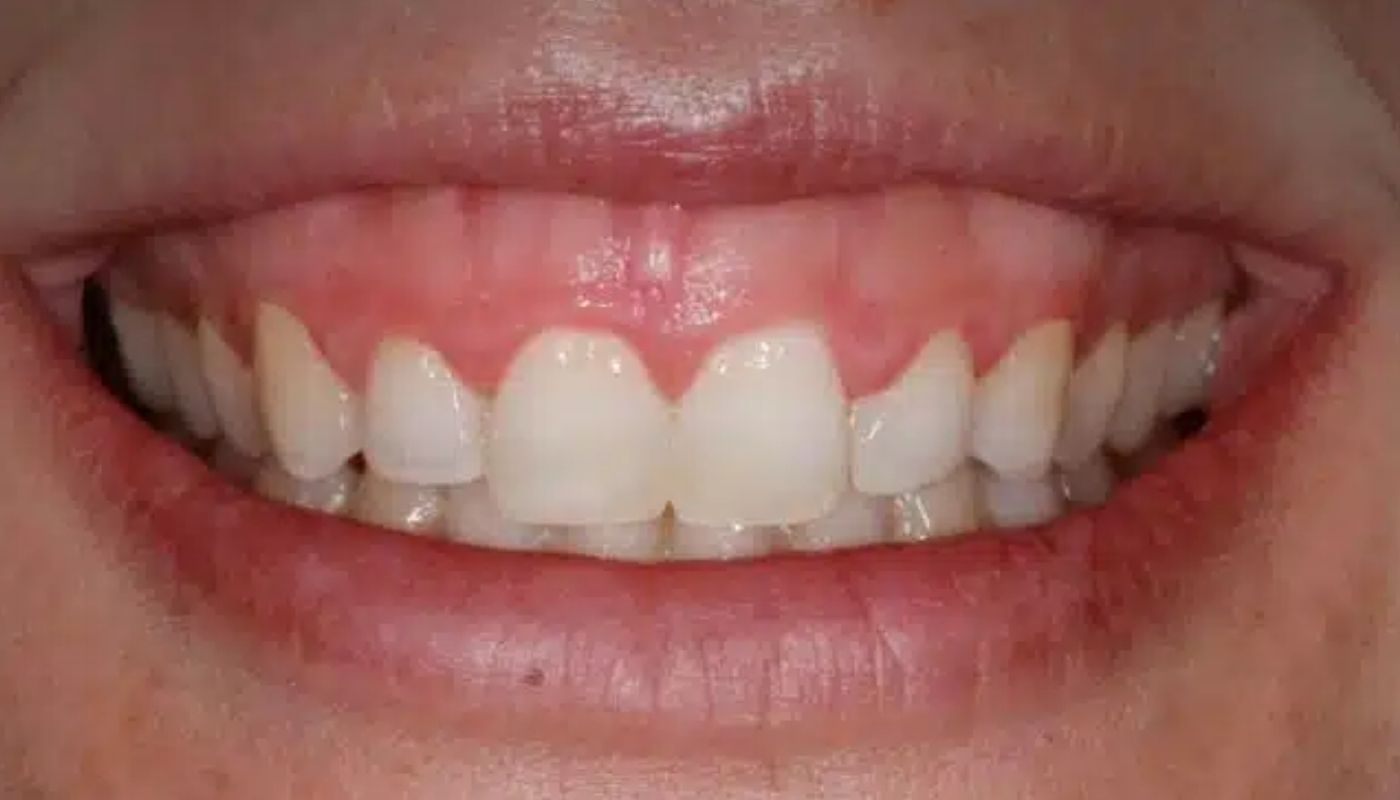 antes y despues